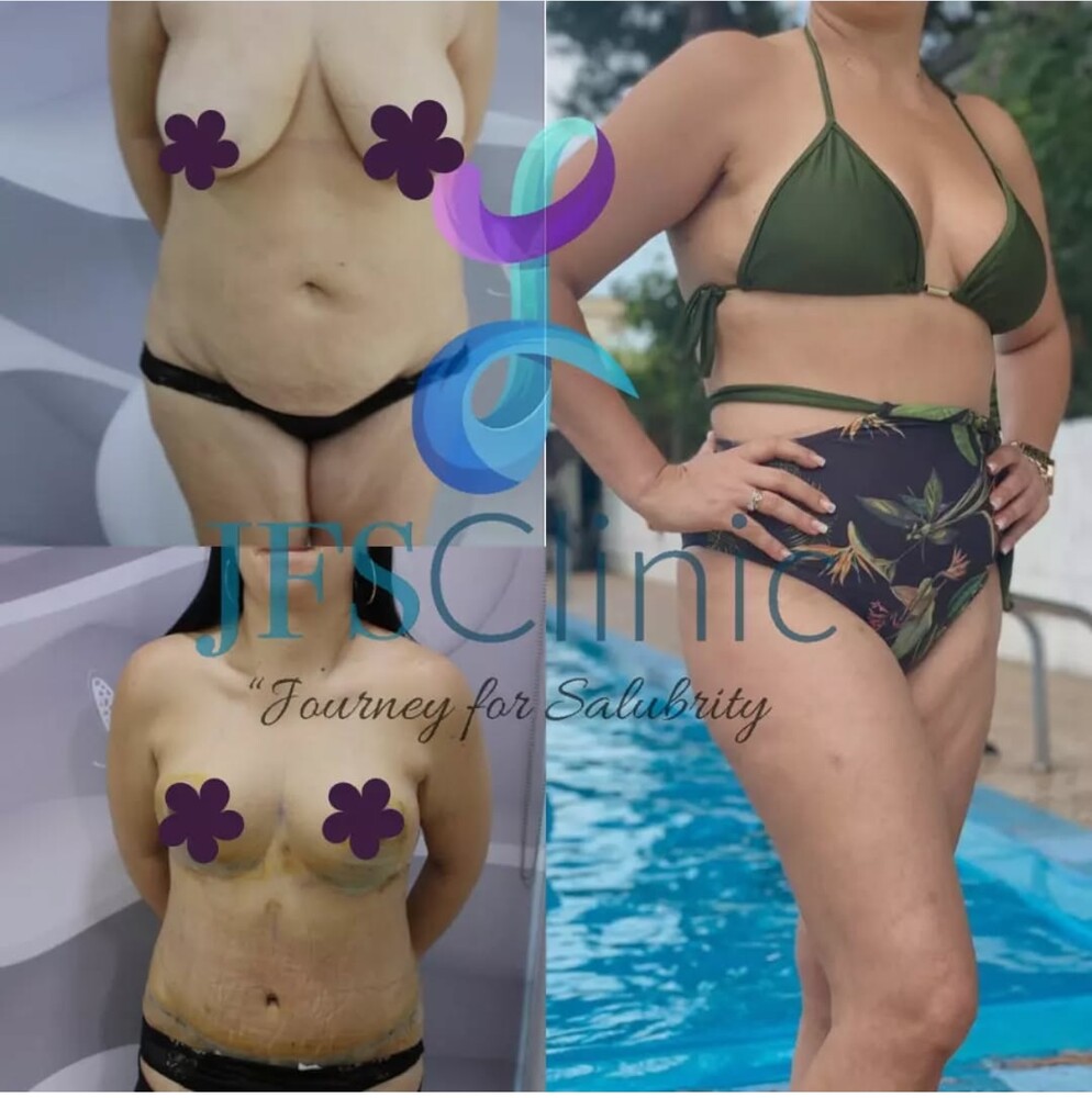 Before and After Result